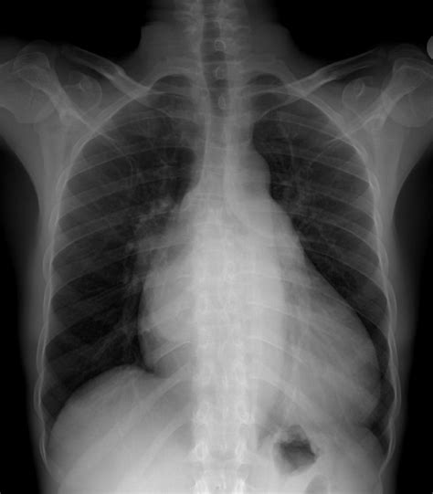 lv enlargement cxr|left ventricular enlargement radiology.